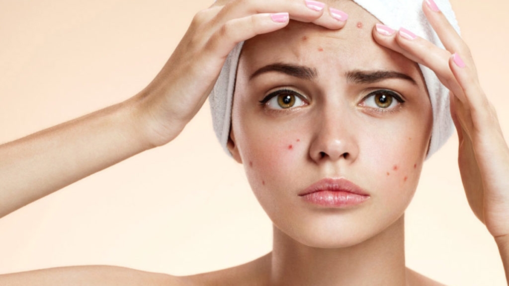 acne prone skin